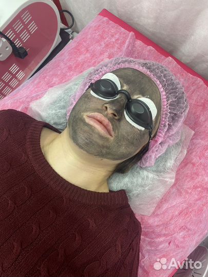 Карбоновый пилинг