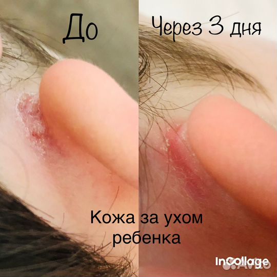 Бальзам от экземы/псориаза/ дерматита и др. 7,5 гр