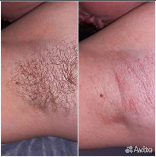 Восковая депиляция