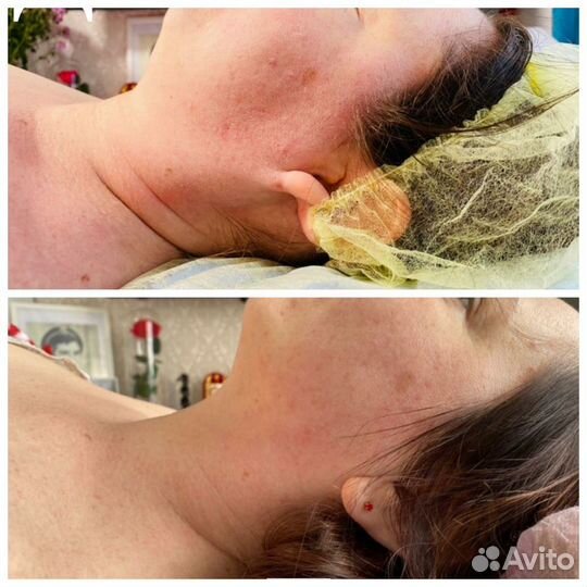 LPG массаж/Сфера