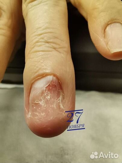 Подологический педикюр