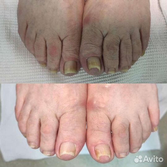 Медицинский педикюр подолог