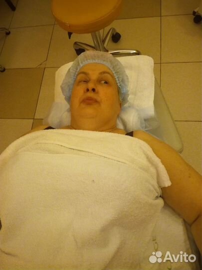 Лифтинг лица -скульптурный, буккальный (подтяжка)