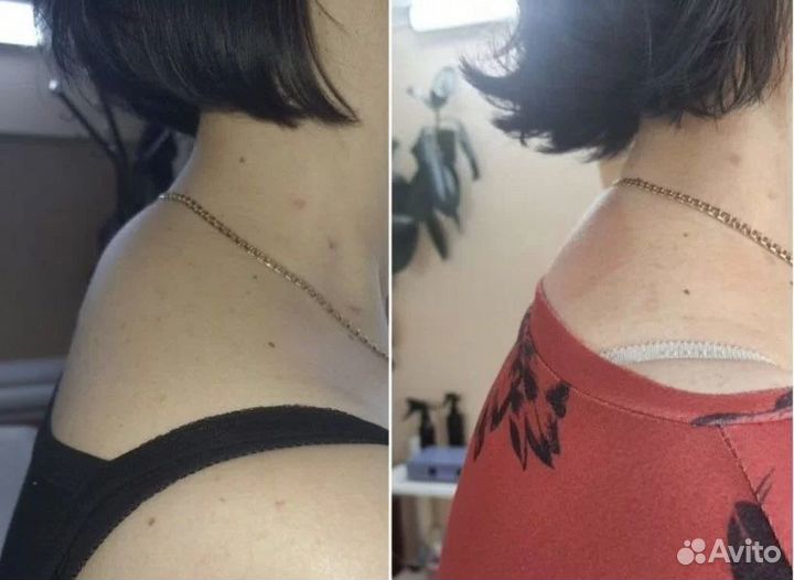 Ищу модель криолиполиз