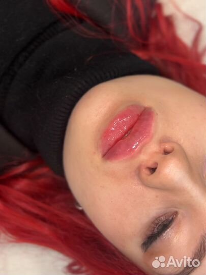 Увеличение губ