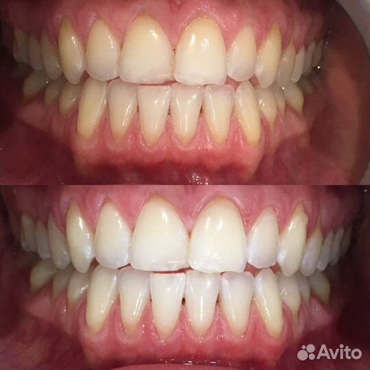 Сертификат на отбеливание зубов