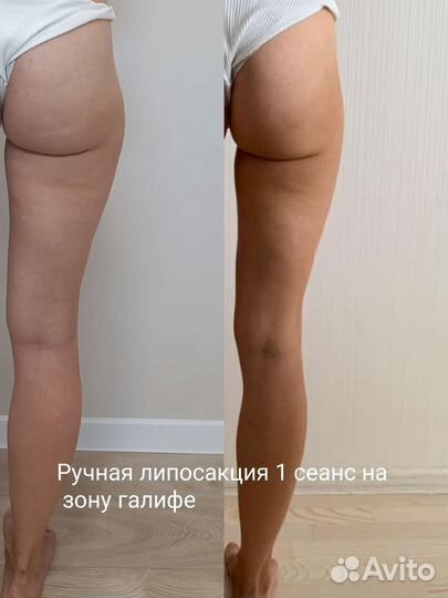 Массаж, ручная липосакция, устранение целлюлита