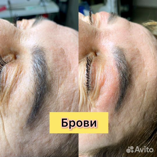 Электроэпиляция