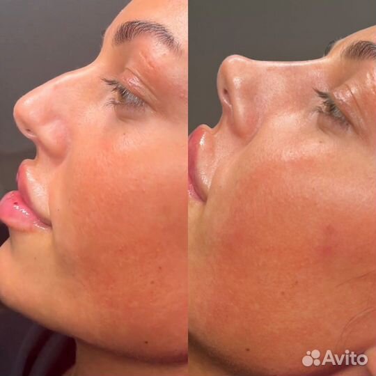 Уменьшение носика навсегда