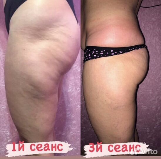 Антицеллюлитный, лечебный, лимфодренажный массаж