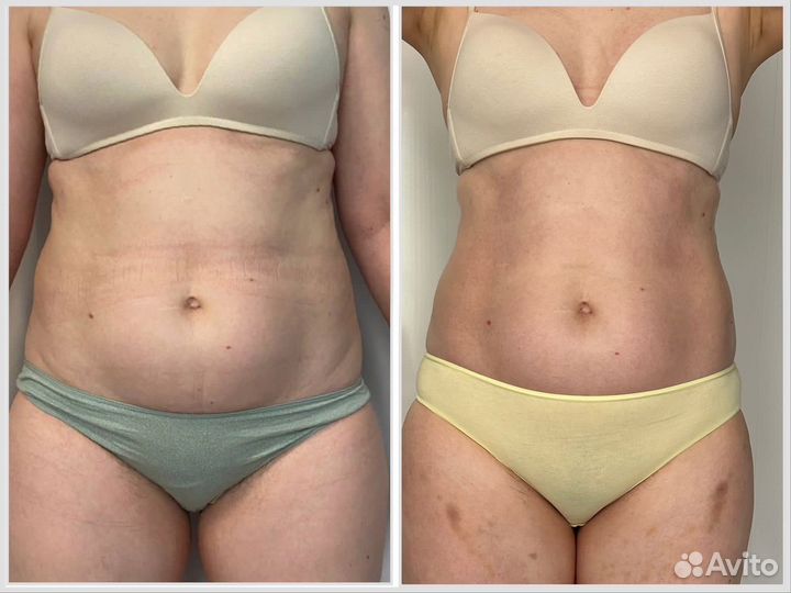 Антицеллюлитный массаж