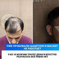 Пересадка волос с гарантией Верните густые волосы, Майкоп
