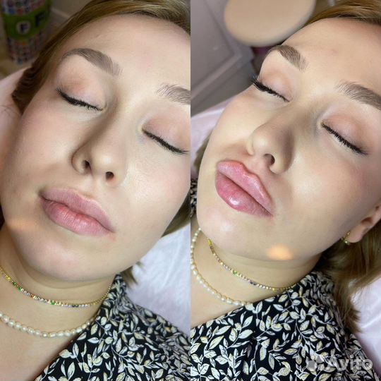 Косметолог. Контурная пластика