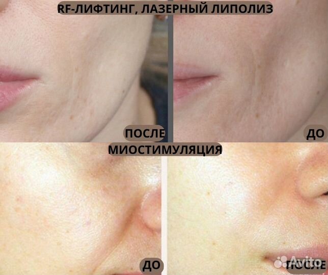 Чистка лица, акне, массаж, ламинир.бровей, ресниц