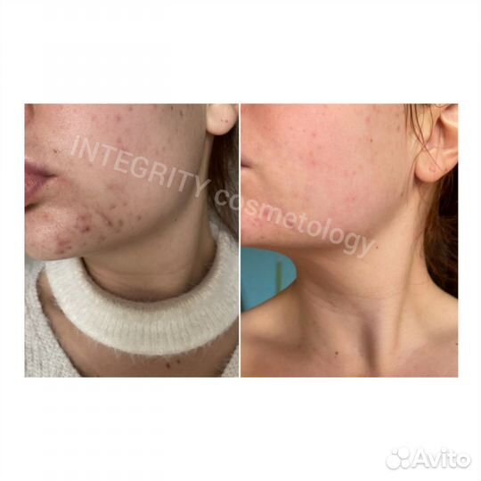 Чистка лица, спины механическая, комбинированная