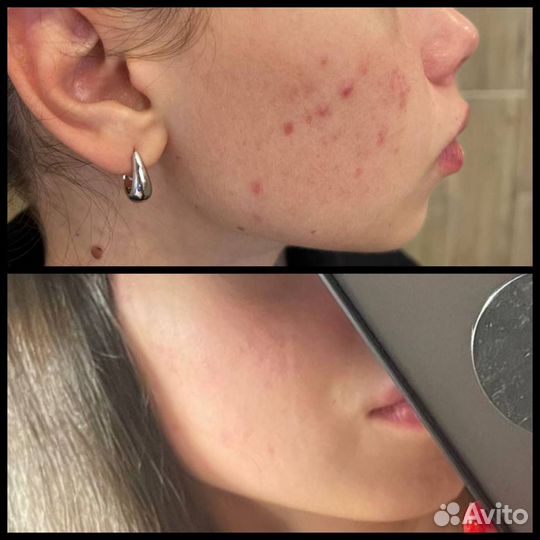 Косметолог, чистка лица, пилинг,омоложение