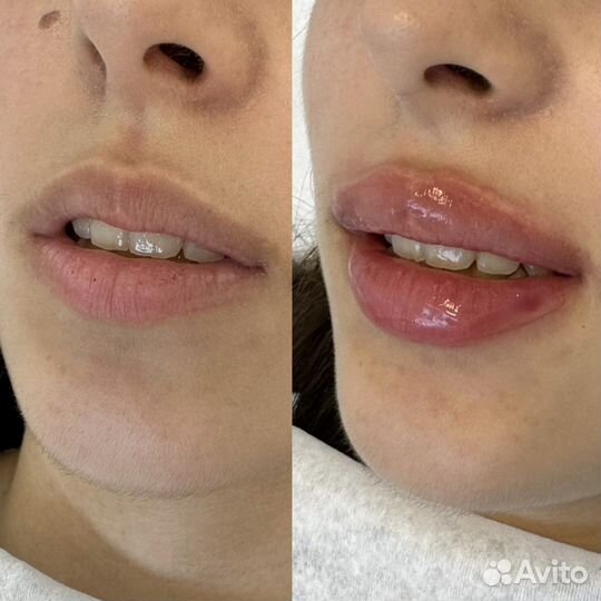Увеличение губ