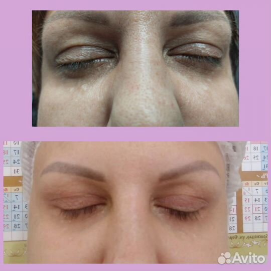 Аппаратная косметология