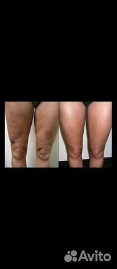 Похудение. Аппаратный массаж