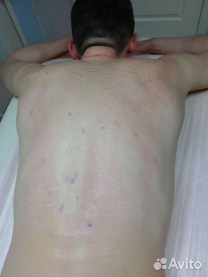 Чистка лица,пилинг,борьба с акне,постакне и др