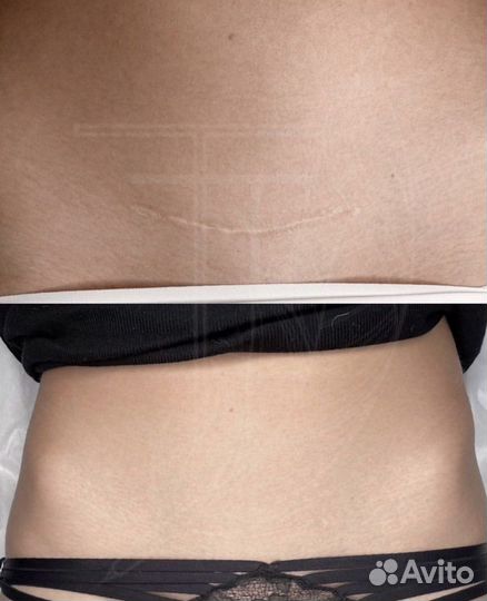 Камуфляж шрамов, растяжек, рубцов