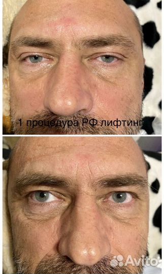 Аппартный массаж для похудения