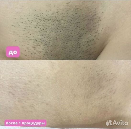 Лазерная эпиляция
