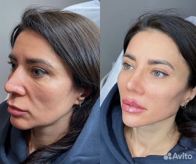 Лицо под ключ Full Face гармонизация обучение