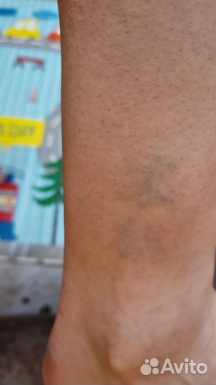 Лазерное удаление тату