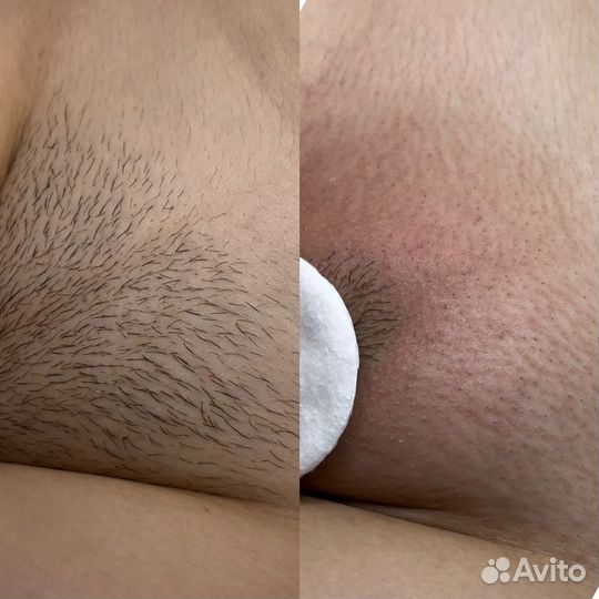 Электроэпиляция