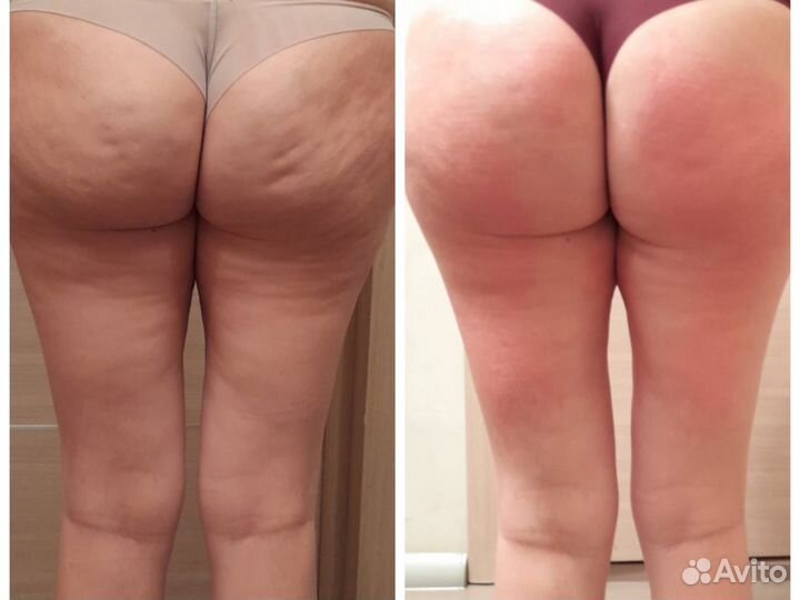 Коррекция фигуры Индиба Похудение