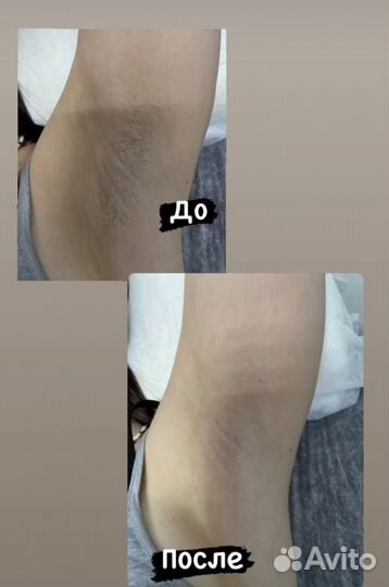 Шугаринг: глубокое бикини