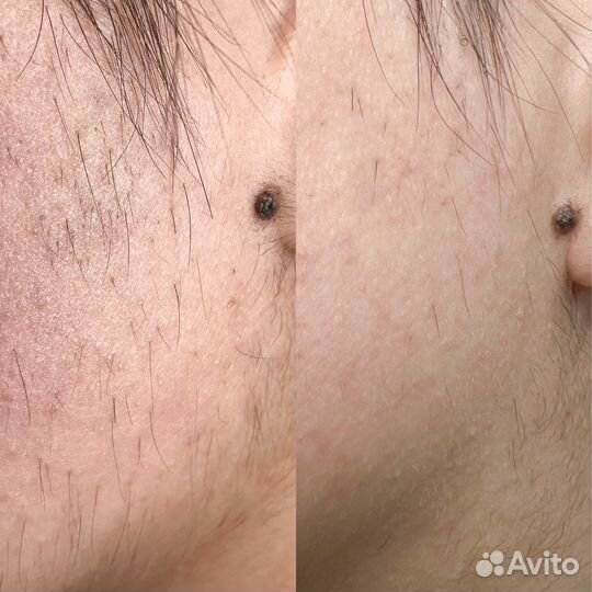 Электроэпиляция