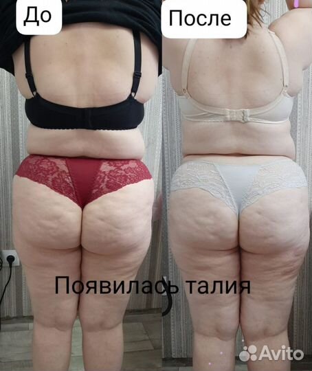 Аппаратный антицеллюлитный массаж