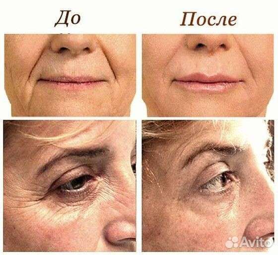 RF-лифтинг для лица