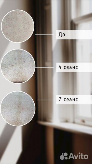 Элос-эпиляция: глубокое бикини