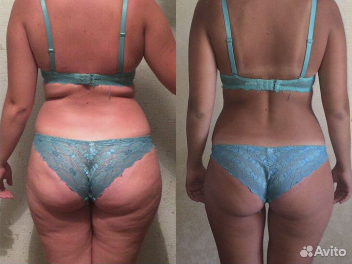 Антицеллюлитный массаж / коррекция фигуры