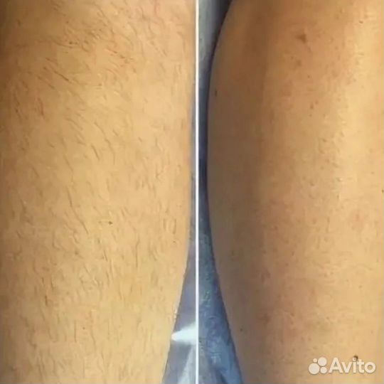 Массаж, Лазерная эпиляция Криолиполиз Smas