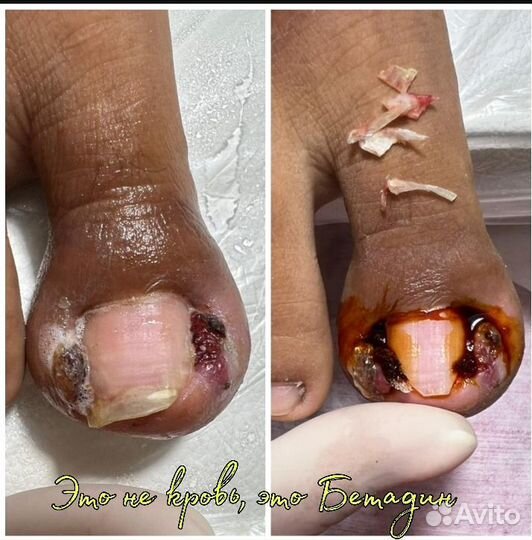 Вросший ноготь, Подология, Педикюр