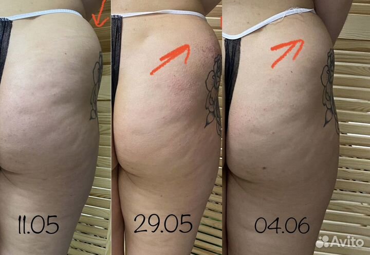 Lpg. Вибро, Вакуум. Кавитация. Массаж лица