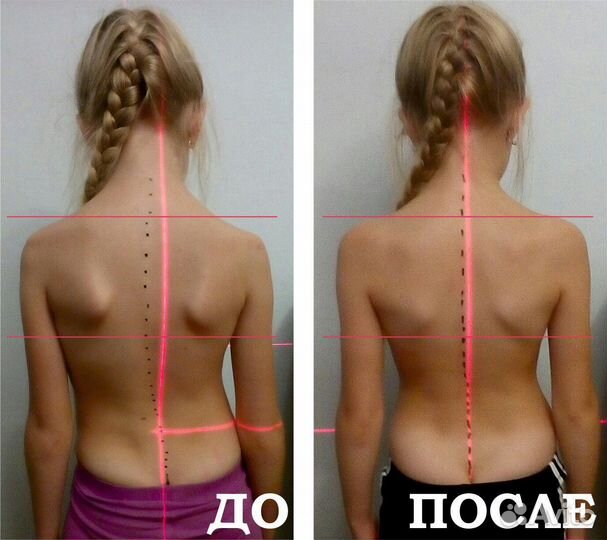 Массаж при сколиозе. Мануал и остеопатия