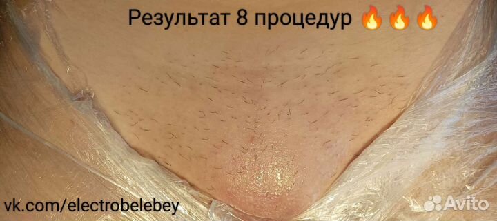 Электроэпиляция