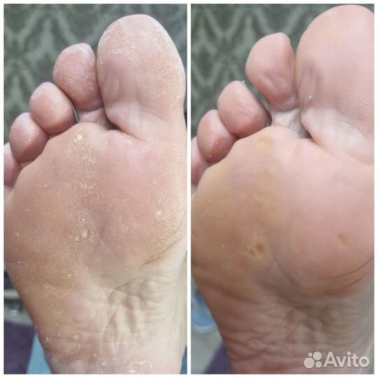 Стержневые мозоли, бородавки, Подолог Липецк