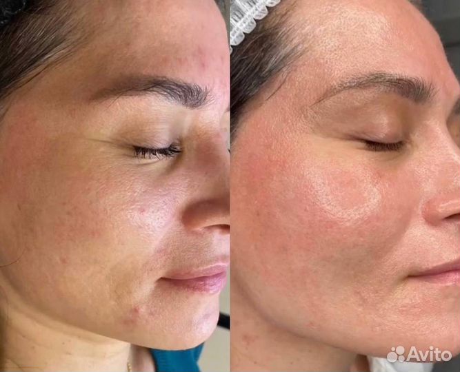 Карбокситерапия oily balance