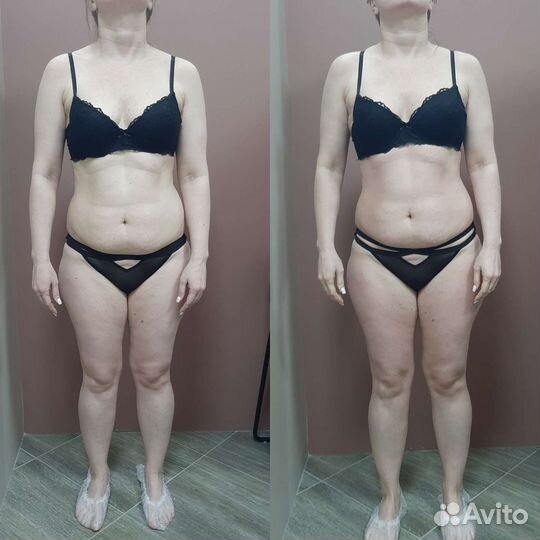 Липопластика тела (ручная коррекция фигуры)