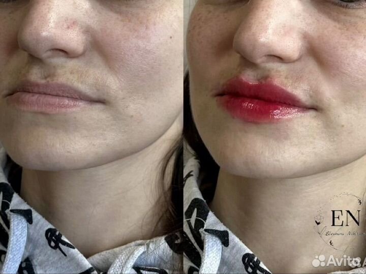 Косметолог:увеличение губ,ботокс,чистка,full face