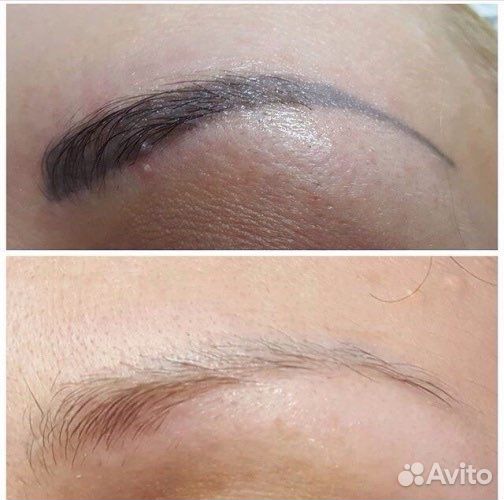 Лазерное удаление татуажа и татуировок