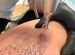Неодимовый лазер для удаления татуировок