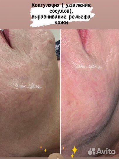 Сосуды/Купероз/Лицо/Тело