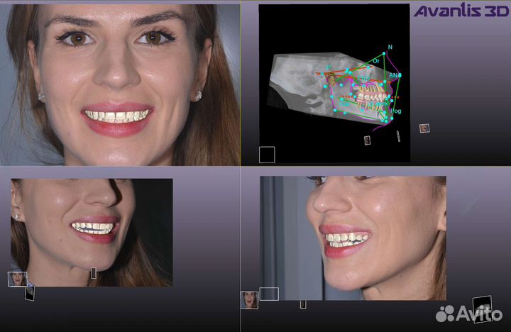Программа для стоматологов Avantis 3D